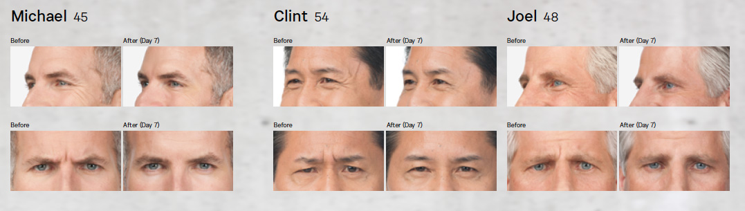 Botox before and after