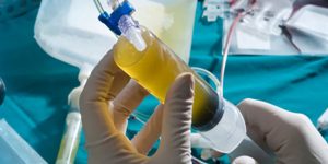 Platelet Rich Plasma therapy