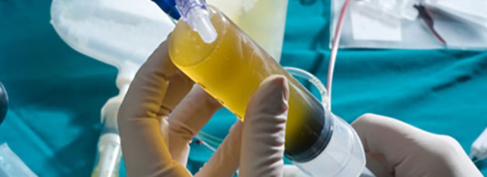 Platelet Rich Plasma therapy